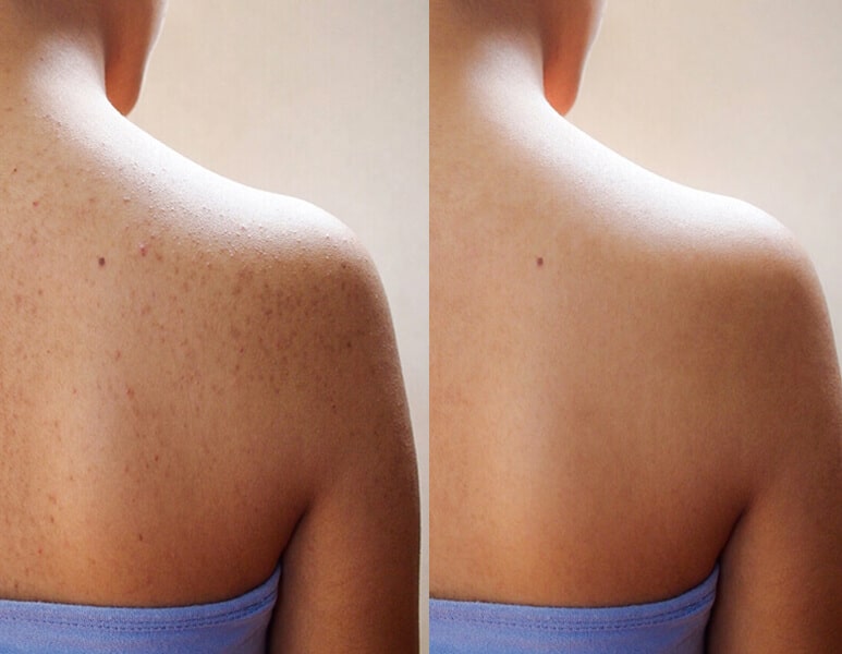 back chemical peel before and after