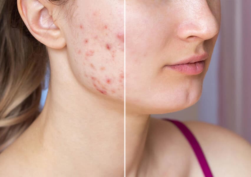 clear skin acne system treatments before and after