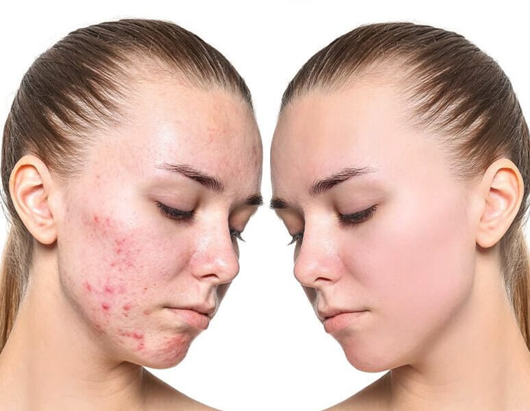 Before and after comparison of acne treatment results, showing clear skin improvement