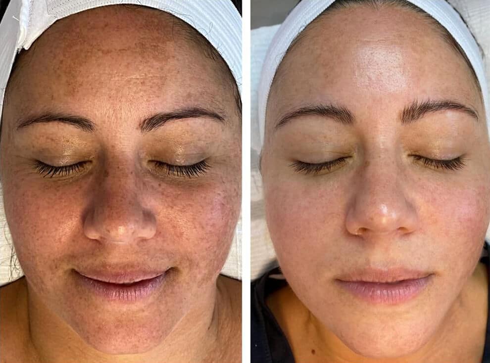 melasma treatment before and after