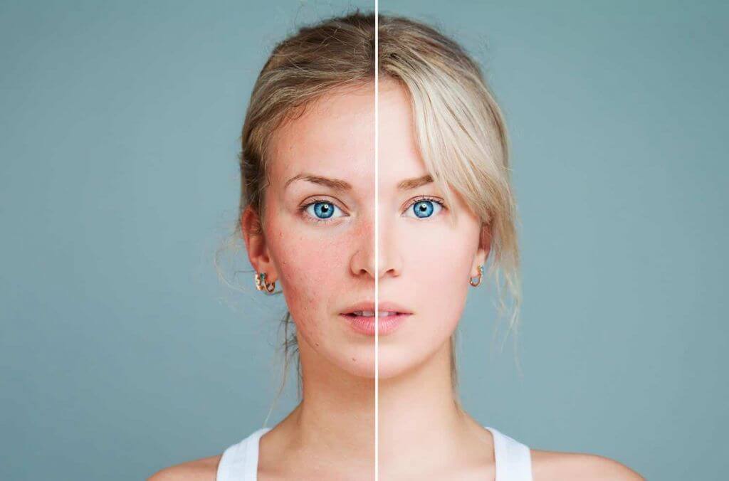 rosacea laser treatment before and after