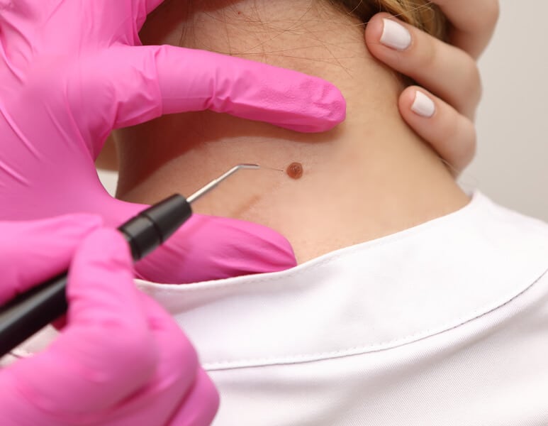 Esthetician performing skin tag removal treatment on a client's neck