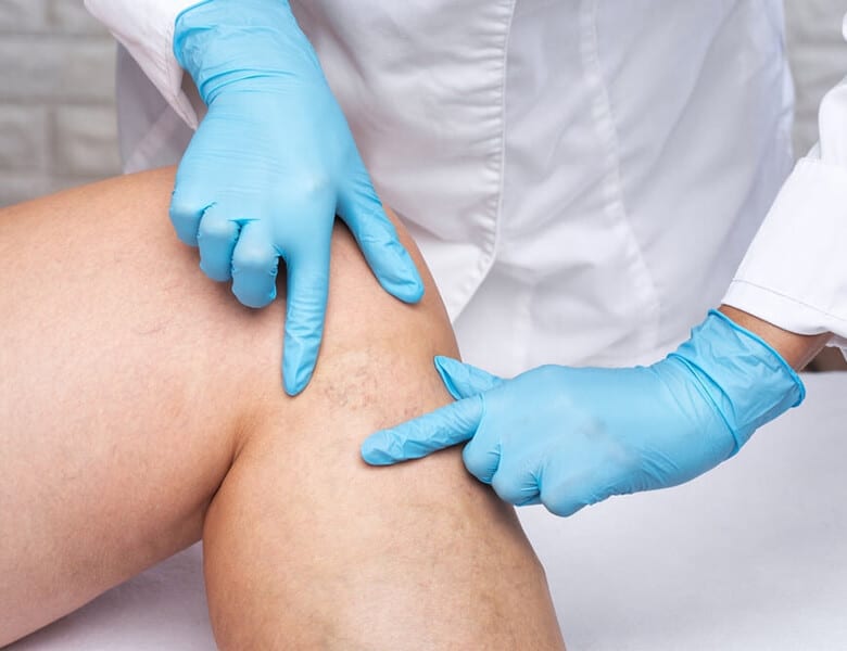 esthetician performing spider veins removal