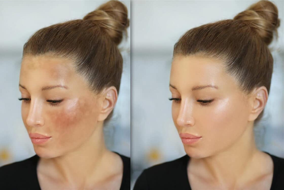 hyperpigmentation laser treatment before and after