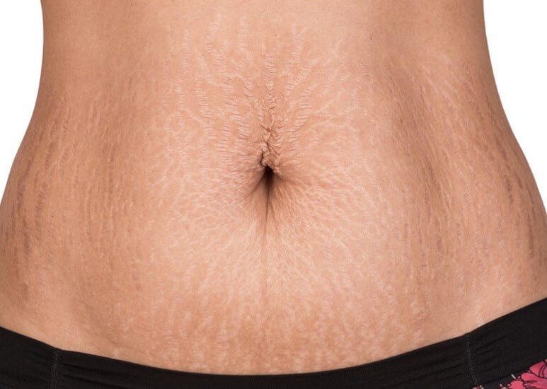 E Matrix treatment for neck and décolleté