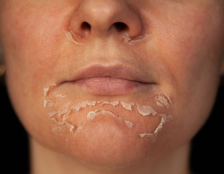 jessner chemical peel