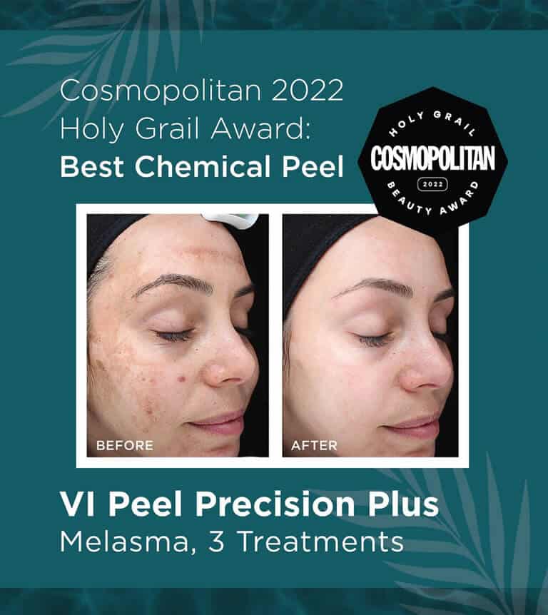 VI Peel before-and-after results of skin treated for melasma and hyperpigmentation