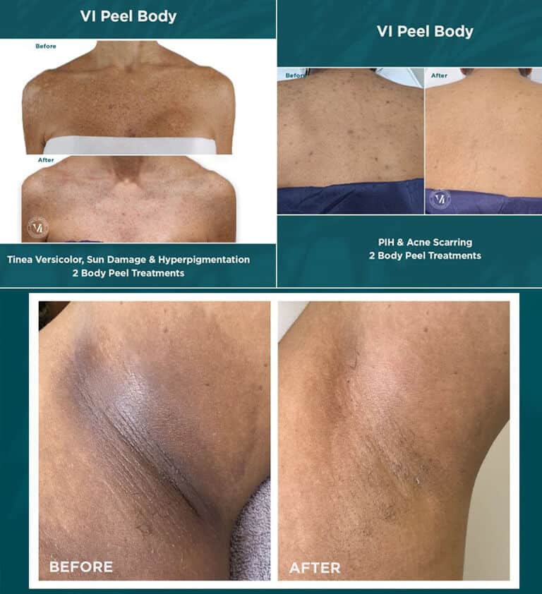 vi peel body treatment before and after back, chest, armpit